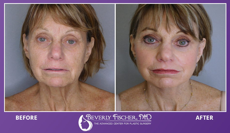 Impressive Info About How To Reduce Facial Swelling After Surgery